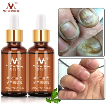 

2Piecses/lot Nail Fungus Treatment / Onychomycosis Paronychia / Anti Fungal Nail Infection Good Result Chinese Herbal Toe Nail