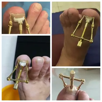 

Unilateral Nail Correction Tool Fixer Recover Toe Paronychia Nail Brace Tools Ingrown Toenails Pedicure Tool 27RC