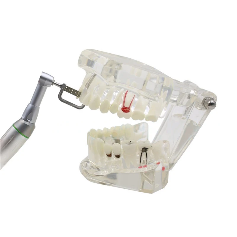 Orthodontics Interproximal Enamel Reduction IPR Contra Angle Kit