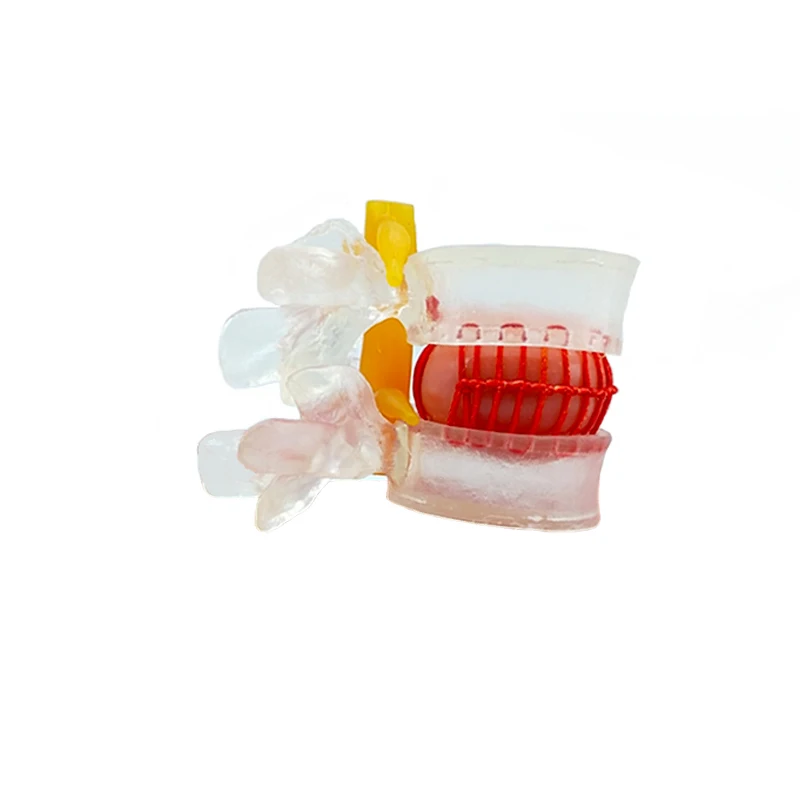 

Transparent Color Human anatomy skeleton Spine Lumbar Disc Herniation Teaching Model school supplies medical instrume
