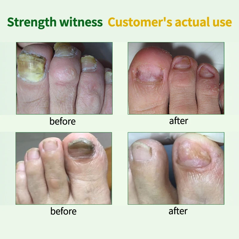 Средство для лечения грибок ногтей жидкий онихомикоз паронихия