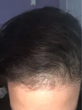 Esencia De rápido crecimiento De pelo, productos Para la pérdida del cabello, Fibras Para el crecimiento del cabello, champú, crema De tratamiento Para el cuidado del cabello