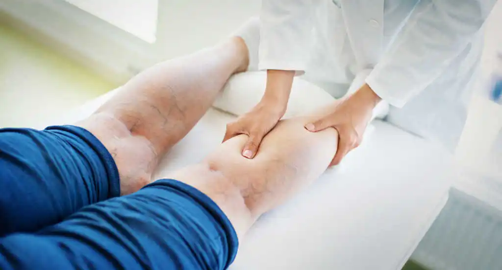 varicose-veins-legs