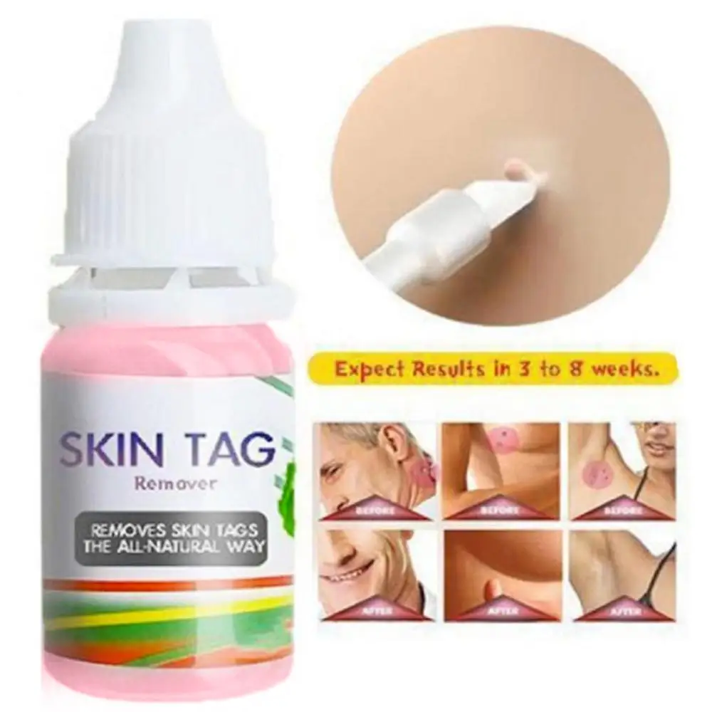 

10ml Skin Tag Remover Liquid Natural Plant Extract Foot Corn Plantar Body Warts Treatment Antibacterial Ointment