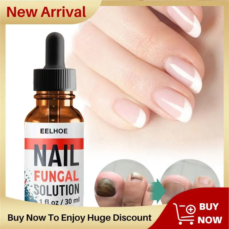 

Fungal Nail Treatment Feet Care Essence Nail Foot Whitening Toe Nail Fungus Removal Gel Anti Infection Paronychia Onychomycosis