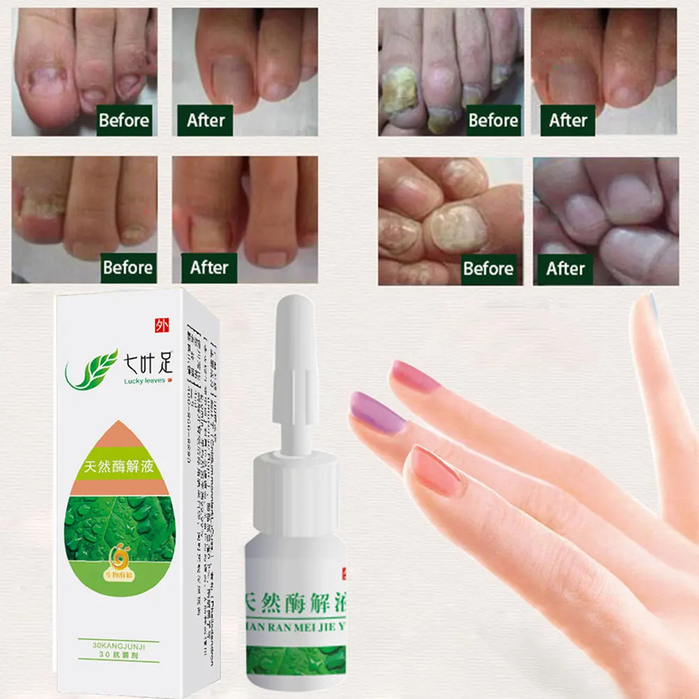 Ringworm Essential Oil Leuconychia Liquid Nails Nursing Portable Onychomycosis Repair Convenient Painless Nail Removal
