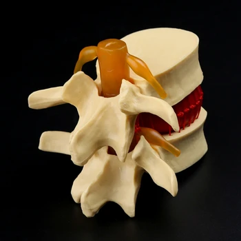 

Medical Science Accessories Anatomical Spine Lumbar Disc Herniation Anatomy Medical Teaching Tool dropshipping