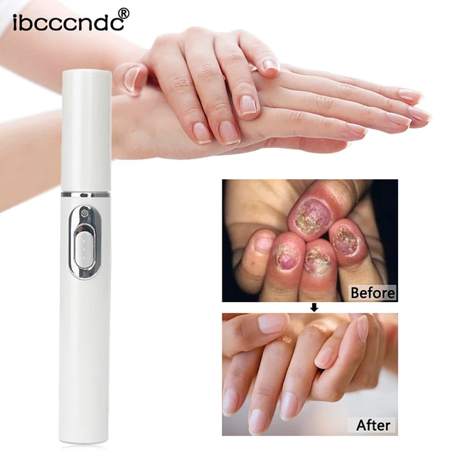 1 Pcs Anti Fungal Onychomycosis Repair Pen Home Set Laser Pen Blue Light Finger Toe Nail Fungus Care Kit White Nail Tools 2