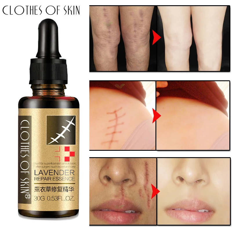 

Lavender Scar Removal Serum Hyaluronic Acid Stretch Marks Acne Scar Repair Essence Nourish Moisturizing Smooth Skin Treatment