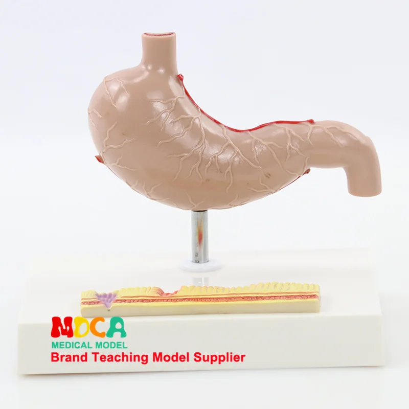 

Pathological Stomach Model Gastrointestinal Human Stomach Lesions Teaching Aids Digestion System Medicine Teaching Mcw008