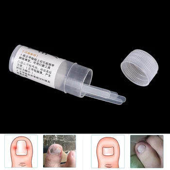 

5pcs Paronychia Correction File Acronyx Wire Corrector Foot Care Tool Ingrown Toe Nail Correction Sticker Patch Hot Sell
