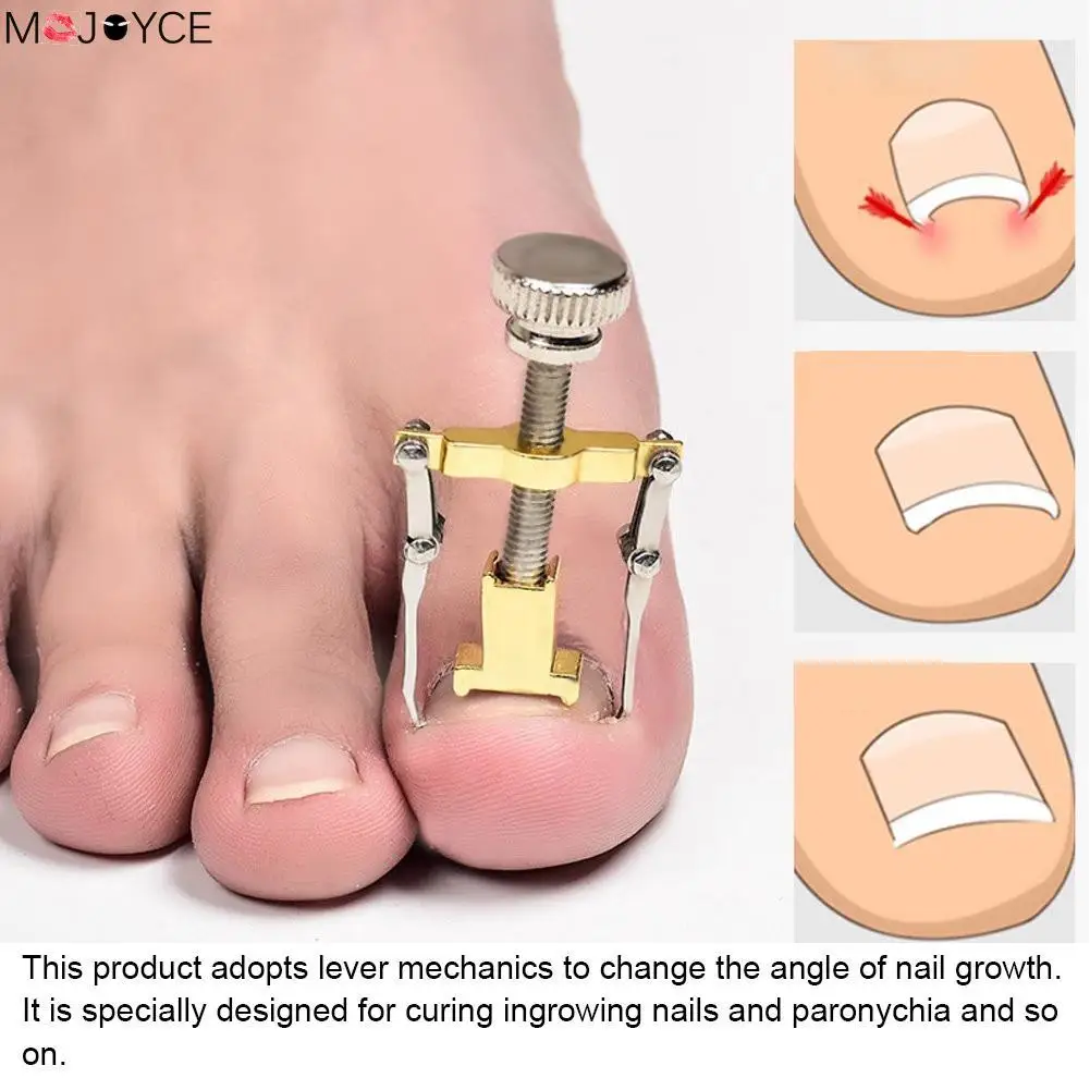 2pcs Ingrown Toe Nail Fixer Pedicure Toenail Recover Nail Correction Tool Nail Corrector Tool Toenail Fixer Foot Care