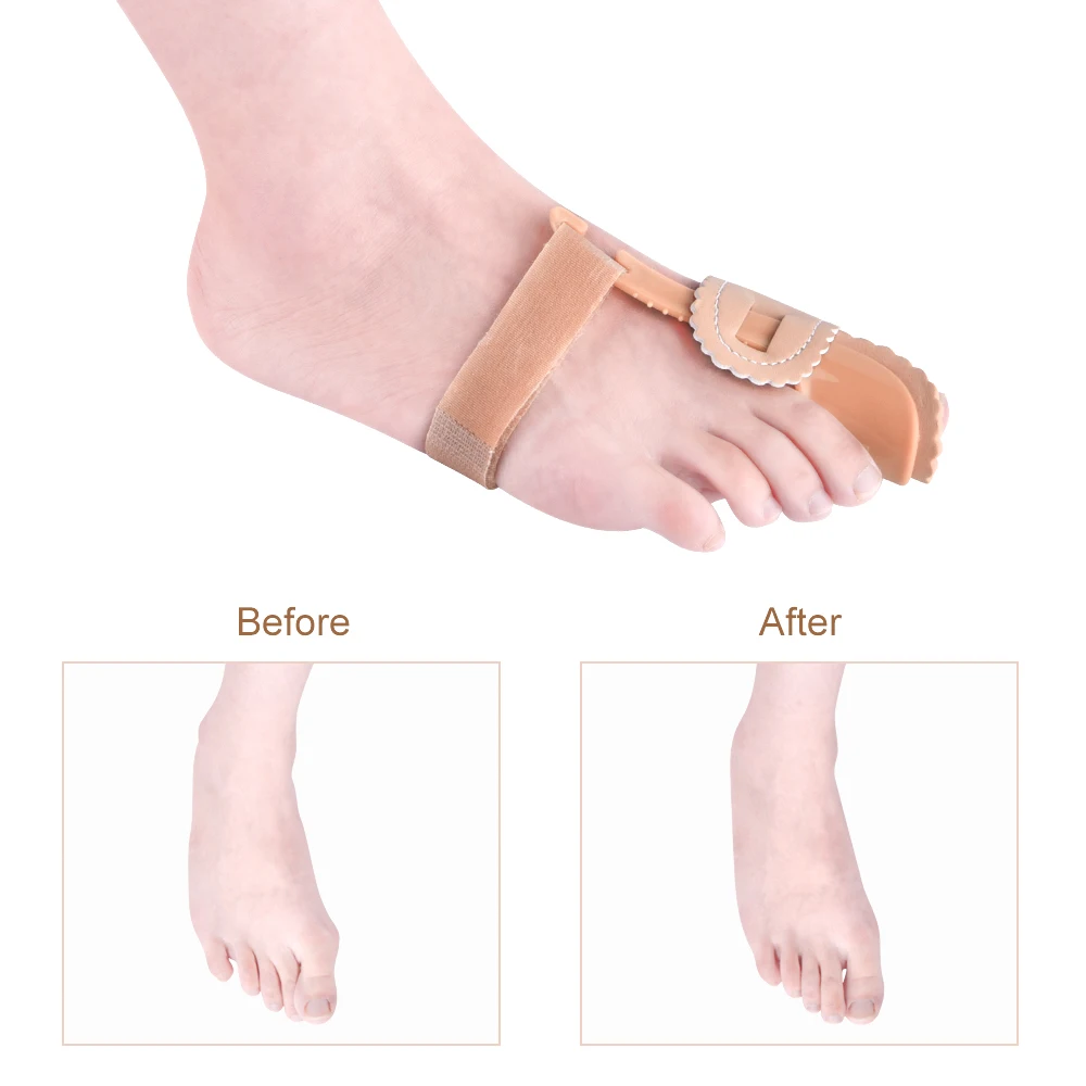 1Pcs Hallux Valgus Splint Correction Bicyclic Bunion Thumb Orthopedic Bone Big Toe Separator Finger Pedicure Foot Care Tool