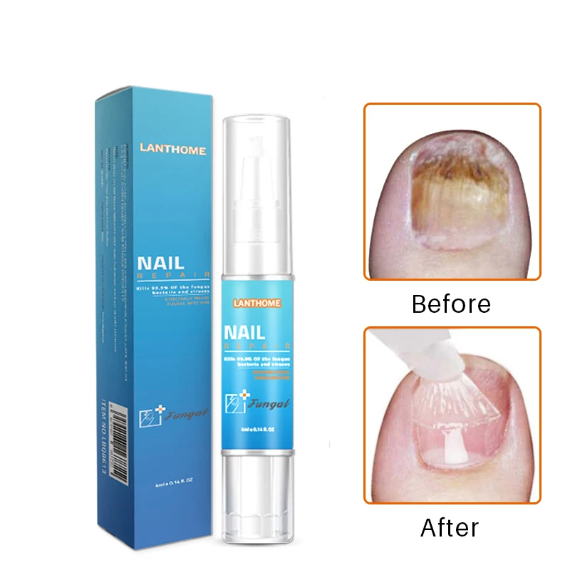 

Fungal Nail Treatment Pen Anti Fungal Nail Repair Serum Cuticle Oil Pen Herb Bright Cream Disinfection Toe Nail Fungus Remover