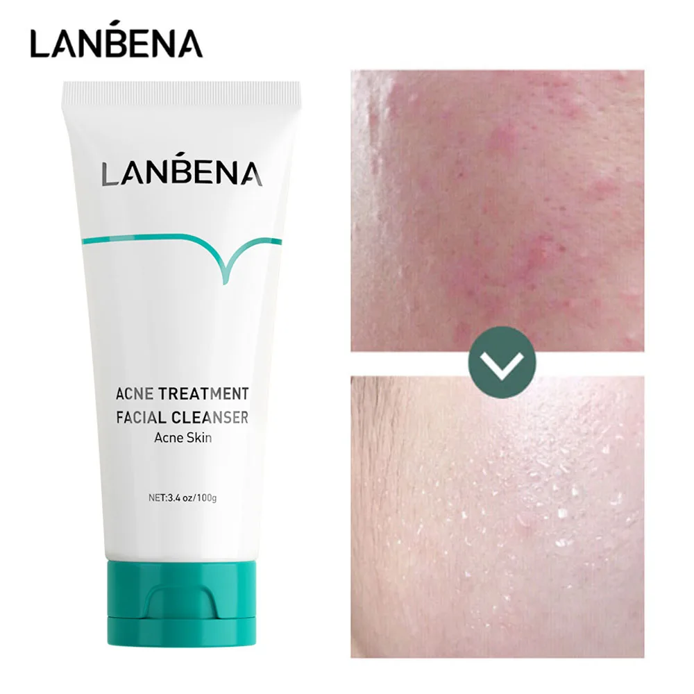 

LANBENA Acne Treatment Facial Cleanser Anti Acne Oil Control Remove Acne Marks Unclog Pore Gentle Clean Face Scrub Wash Foam