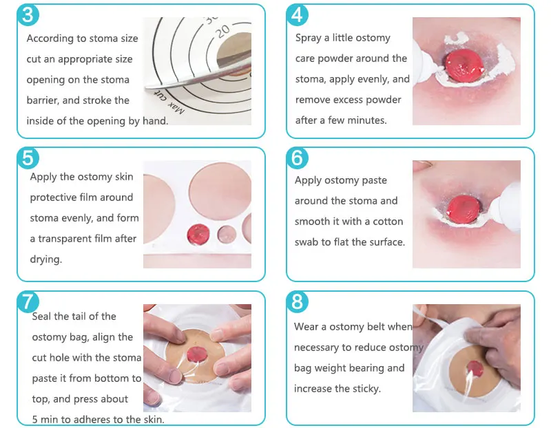 clipes, Material de malha respirável, Ostomia Sacos,