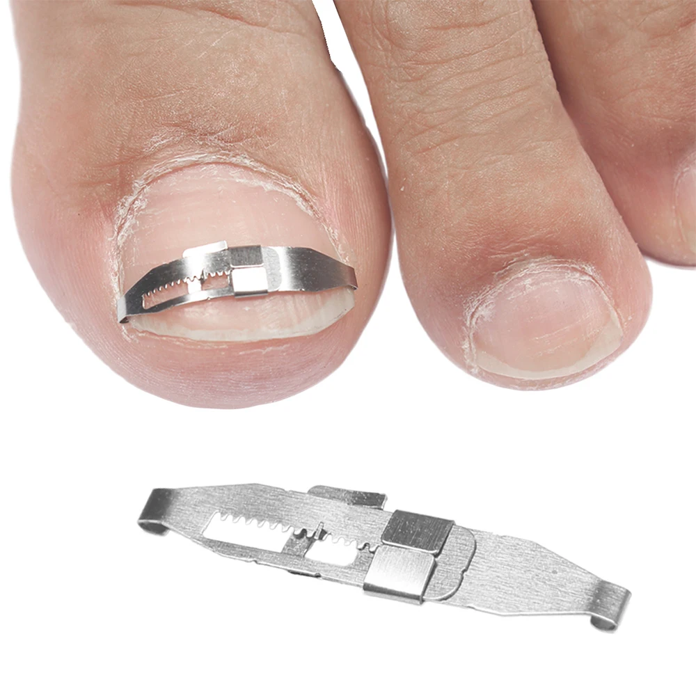 1Set Ingrown Toe Nail Correction Tool Toenail Straightening Correctors Patch Tool Kit Nail Repairer Orthosis Beauty Tools
