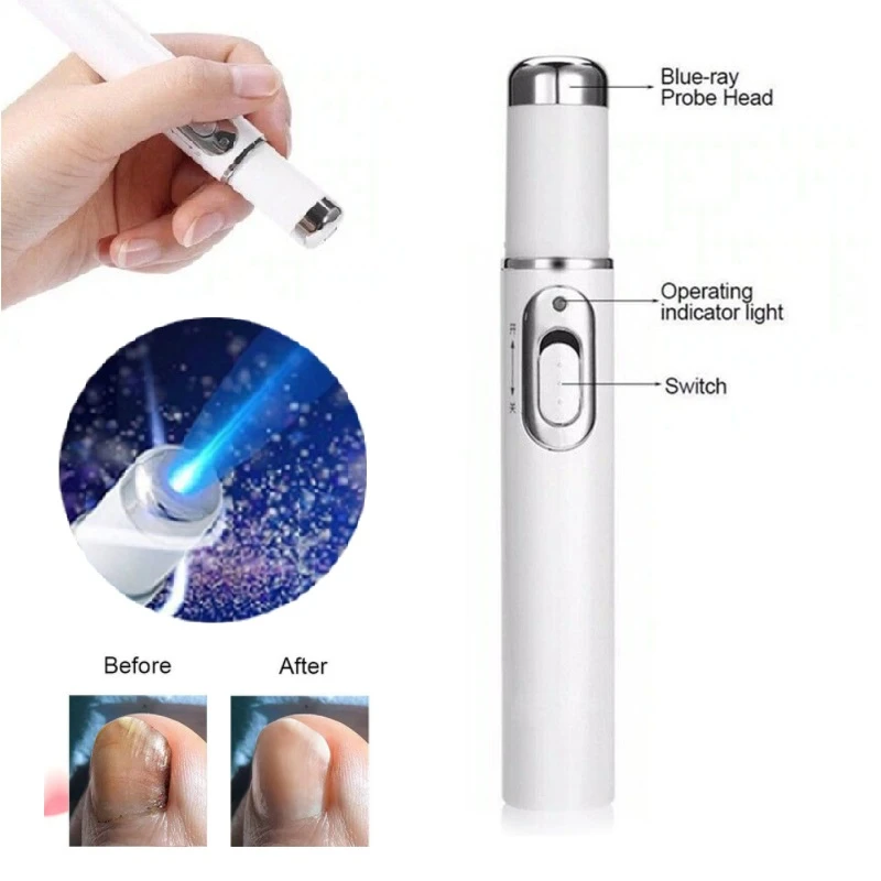 Hot Nail Fungal Pen Anti Fungus Blue Light Laser Pen Onychomycosis