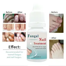 Растительные экстракты Уход за ногами Лечение ногтей жидкий грибковый рингчервь RemovSQ