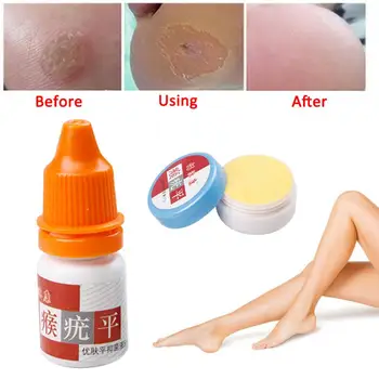 

Warts Treatment Liquid 5ml Cream 10g 12 Cotton Swab Suit Remover Skin Tag Skin Care Medical Ointment