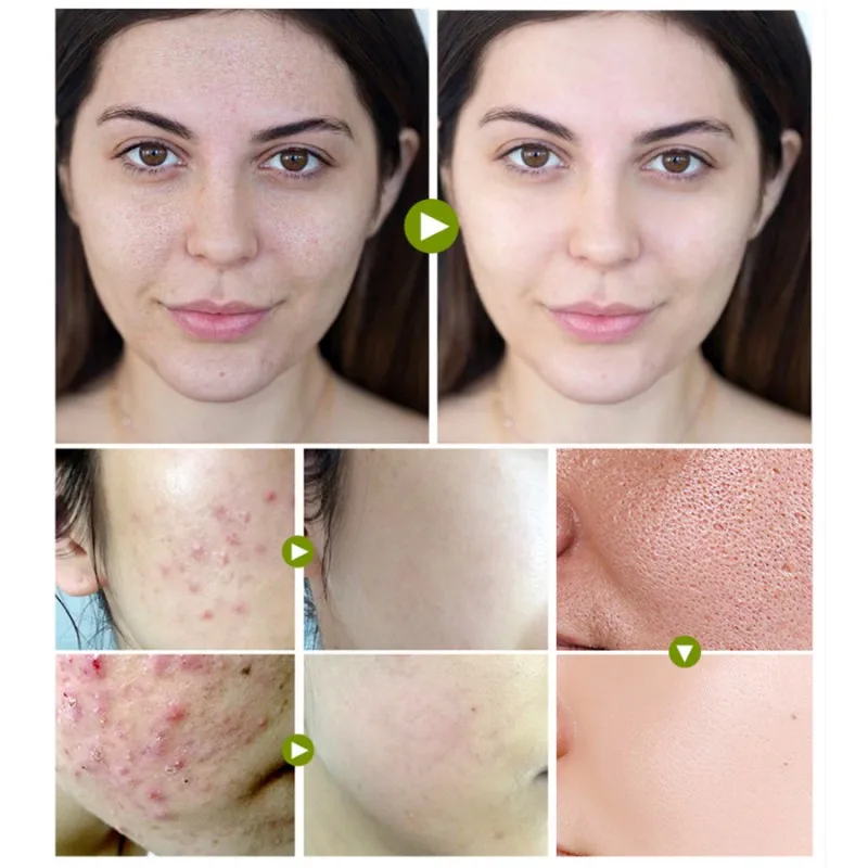 Acne Treatment Cream Anti Pimple Removal Spots Oil Control Shrink Pores Moisturizing Skin Care Serum