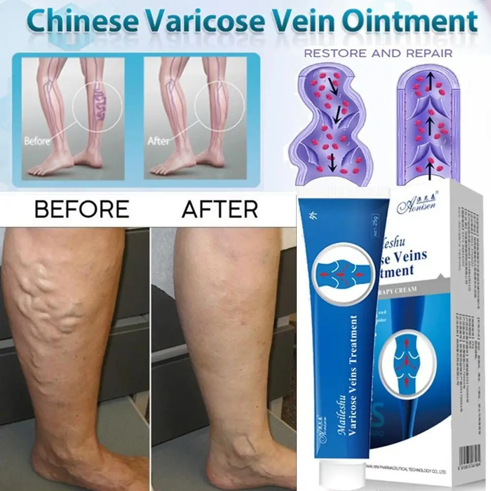 

Varicose Veins Ointment Treatment For Relief Phlebitis Angiitis Leg Smearing Cream Remedies For Spider Varicose Veins Cream 20g
