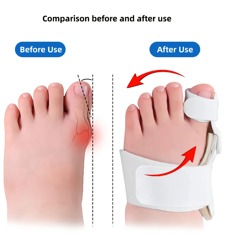 2/3Pieces Hallux Valgus Corrector Big Toe Straightener For Children Bunion Splint Foot Pain Relief Orthopedic Supplies Care Tool