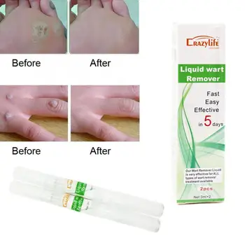 

3ml*2pc Skin Tag Remover Pen 12 hours Tu kill Medical Wart Corn Tag Removal Genital Remover Foot Skin kill Mole Pen Remover J1A7