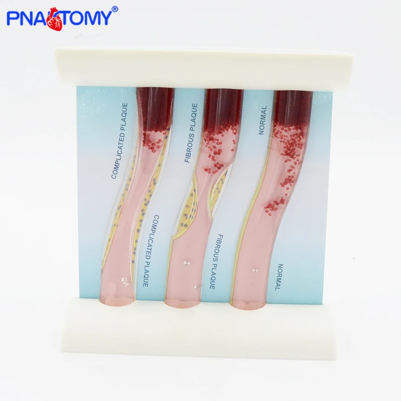 Модель кровеносных сосудов человеческие артерии гиперлипидемия медицинский