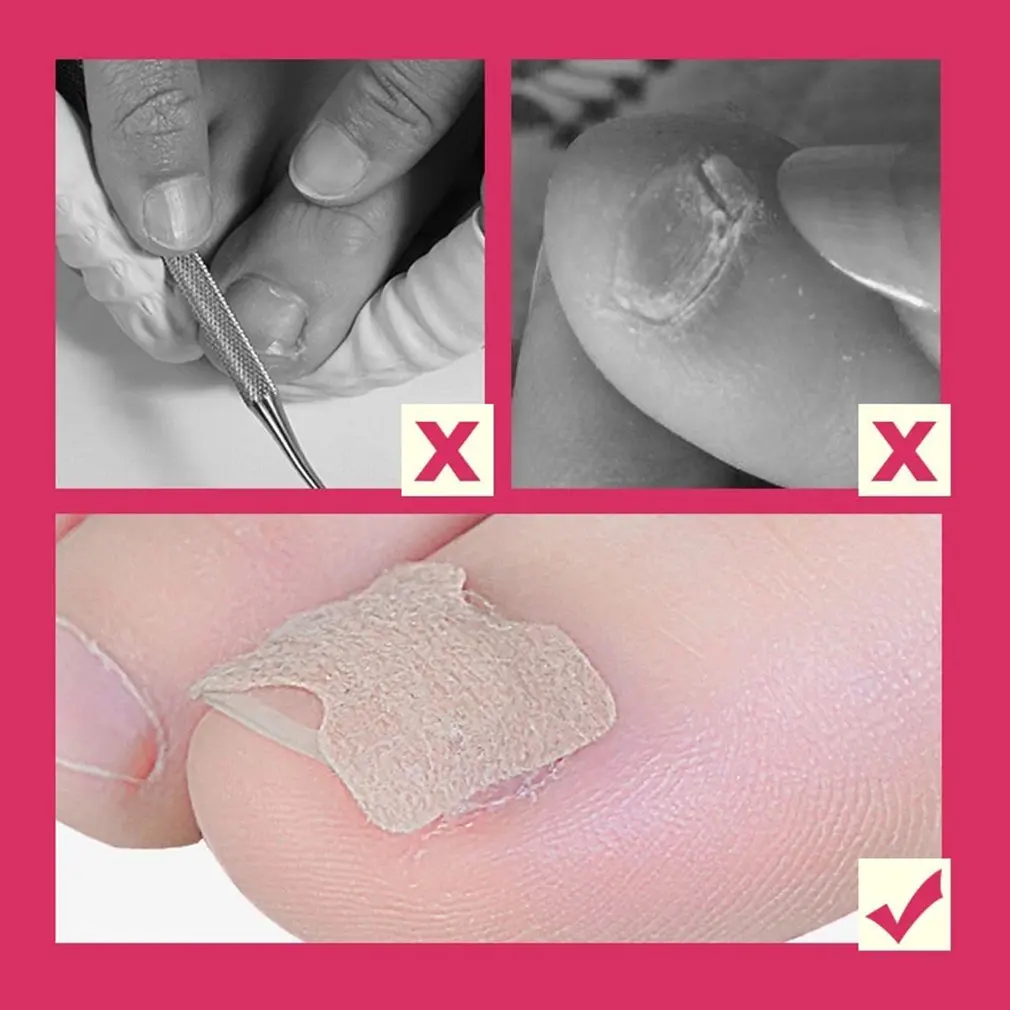 Nail tape stickers Anti-roll nails glue-free toe inlay nails corrector nail patch pull manicure dedicated sticker