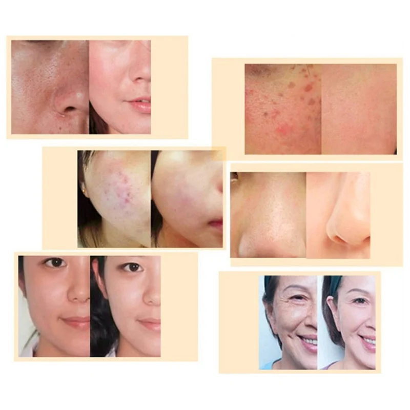 DARSONVAL 192 derma roller micro needles titanium microneedle mezoroller machine for for skin care and hair-loss treatmentDARSON