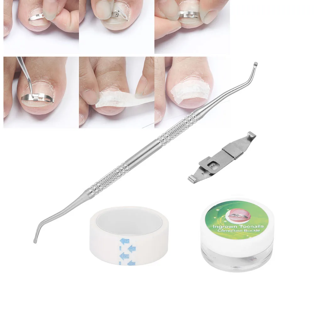 3pcs Ingrown Toenail Corrector Paronychia Treatment Nail Correction Buckle Adhesive Tape Set Ingrown Toenail Correctors 3pcs Ingrown Toenail Corrector Paronychia Treatment Nail Correction Buckle Adhesive Tape Set Ingrown Toenail Correctors