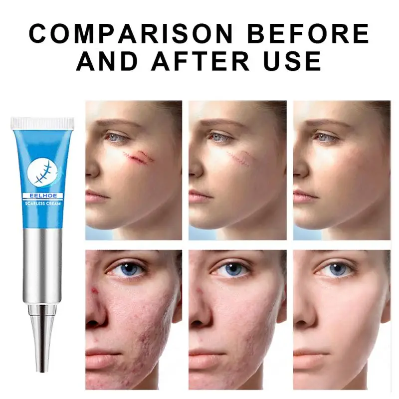 cream for marks on face