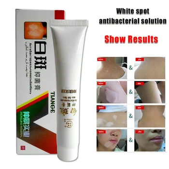 

Herbal Cream for Vitiligo White Spots Leukoplakia Disease Treatment can CSV