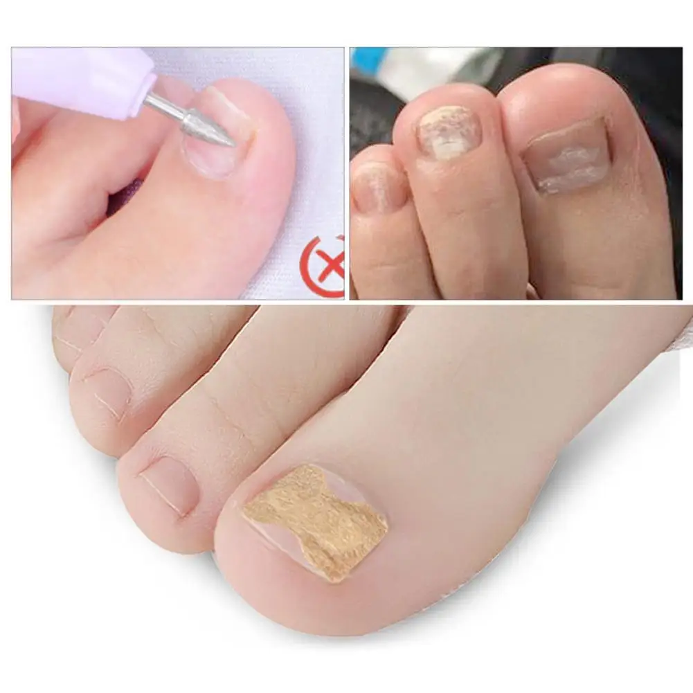 

50Pcs Ingrown Toe Nail Correction Sticker Paronychia Foot Pedicure Corrector
