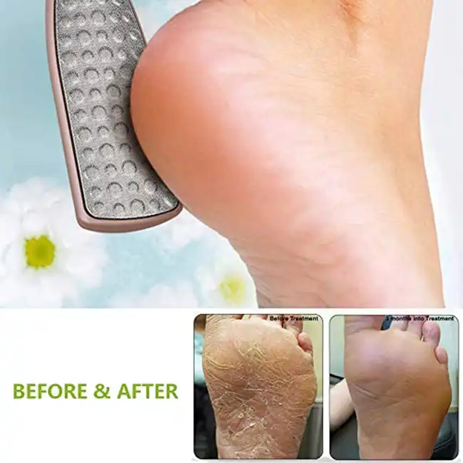 callus crack