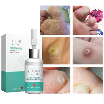 

10ml Foot Antibacterial Agents Remove Warts Dead Skin Corns Bacteriostatic Anti-Itching Foot Care Liquid Foot Skin Care Product