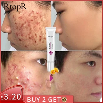 

Acne Treatment Face Cream Blackhead Repair Oil Control Shrink Pores Scar Moisturizer Skin Care Korean Cosmetics Whitening Creams