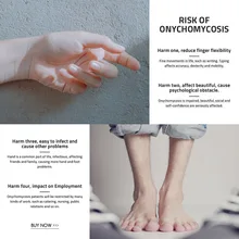 Горячая лечение грибков ногтей против грибка удаление онихомикоза Уход за ногтями уход за ногтями жидкость для восстановления CNT 66