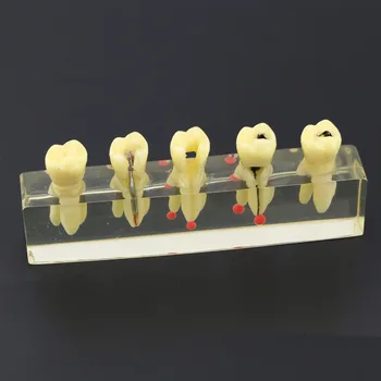 

Dental Study Teach Teeth Model Endodontic Treatment Demonstration Model 4012