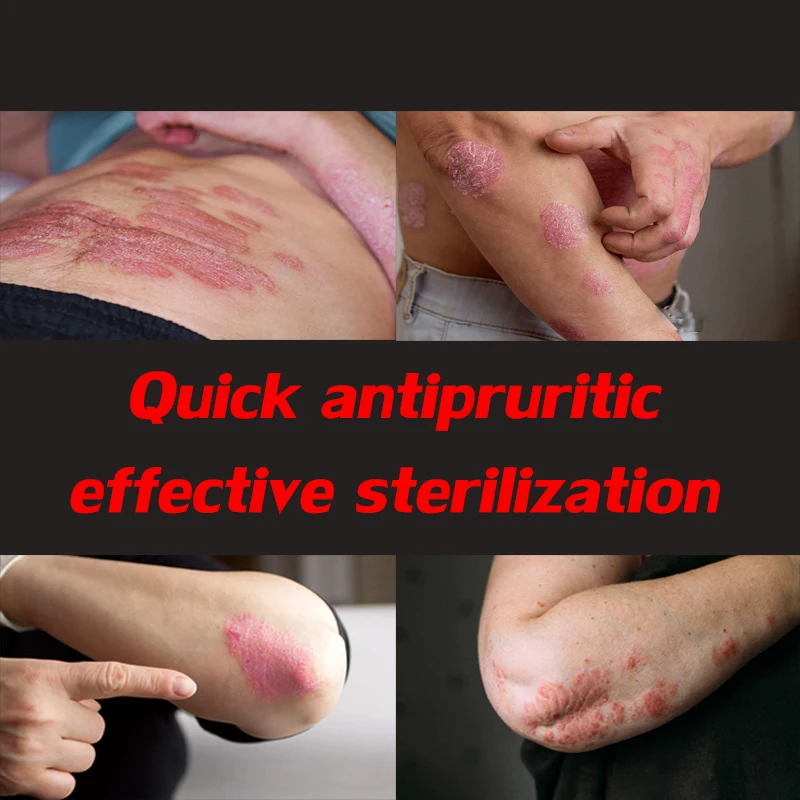 1pcs Skin Care Cure Psoriasis Ointment Ringworm Cream Tinea Eczema Treatment All Skin Types Natural Cream Eczema Skin Pruritus