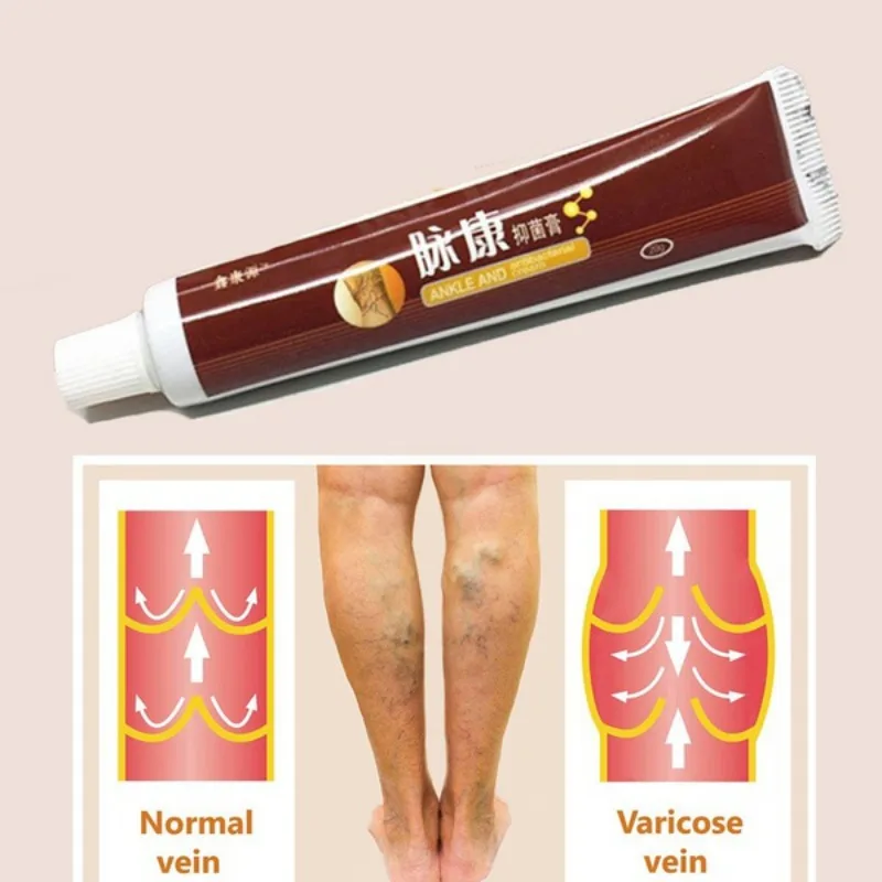 Varicose Vein Ointment Dredge Blood Vessels Spider Veins Vasculitis Treatment Product | Красота и здоровье