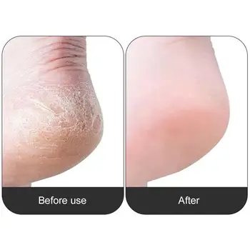 

Exfoliating Foot Peel Pumice Stone Foot Rub Feet Dead And Feet Tool Removal Itching Skin Stop Make Comfortable Pedicure Smo D7Y6
