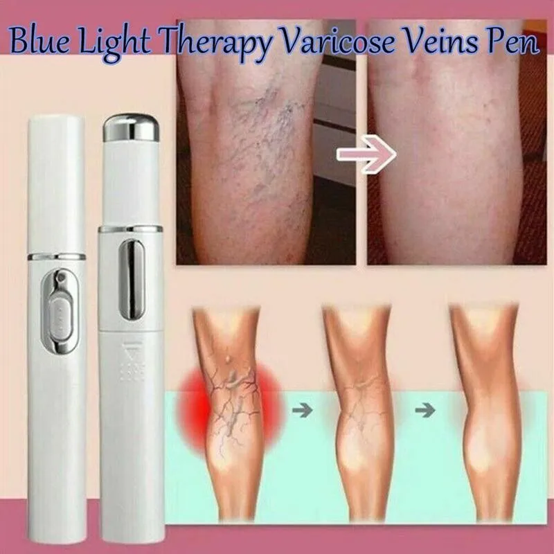 Blue Light Therapy Varicose Vein Pen Medical Varicose Scar Vein Pen Light Blue Acne Therapy Treatment P0R3 4