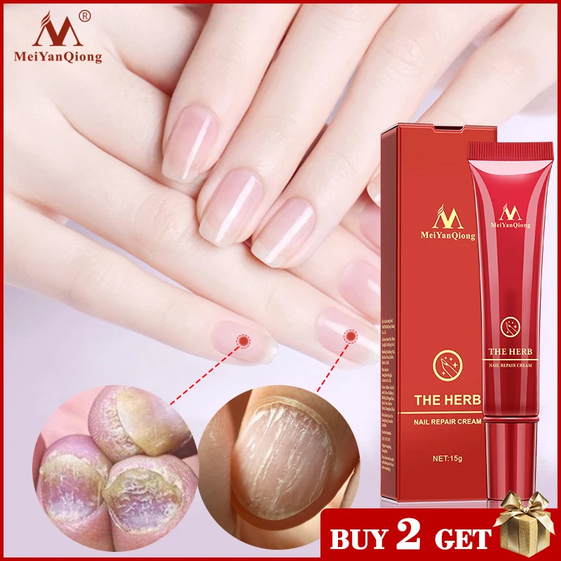 

Herbal Nail Treatment Onychomycosis Paronychia Anti Fungal Nail Infection Good Result Chinese Herbal Toe Nail Fungus Treatment