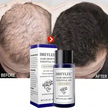 BREYLEE aceite esencial para el crecimiento rápido del cabello, tratamiento para el cuero cabelludo, previene la pérdida de cabello, repara el adelgazamiento, productos de belleza, suero para el cabello 20ml