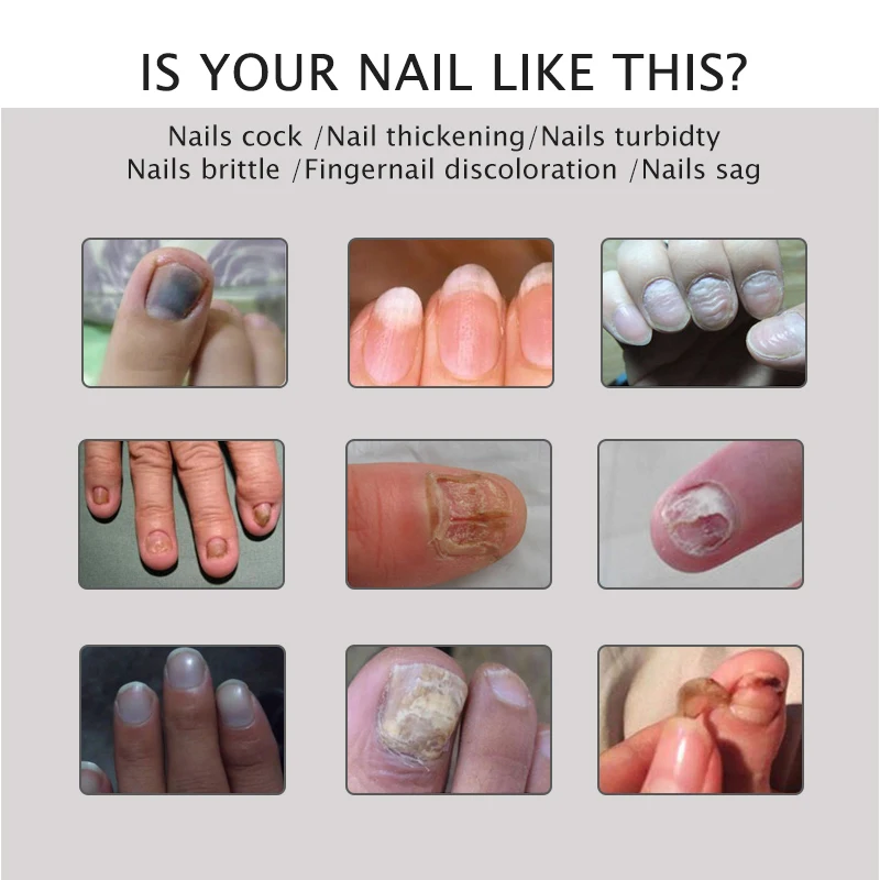 Eelhoe 20g Nail Repair Gel Fungus Treatment Solution (CD126) Extra Mart BD