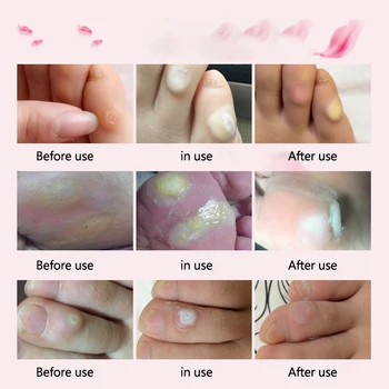 

10ml Care Liquid Mole Foot Corn Effective Exfoliating Scrub Nevus Warts Treatment Callus Portable Health Skin Tag Remover