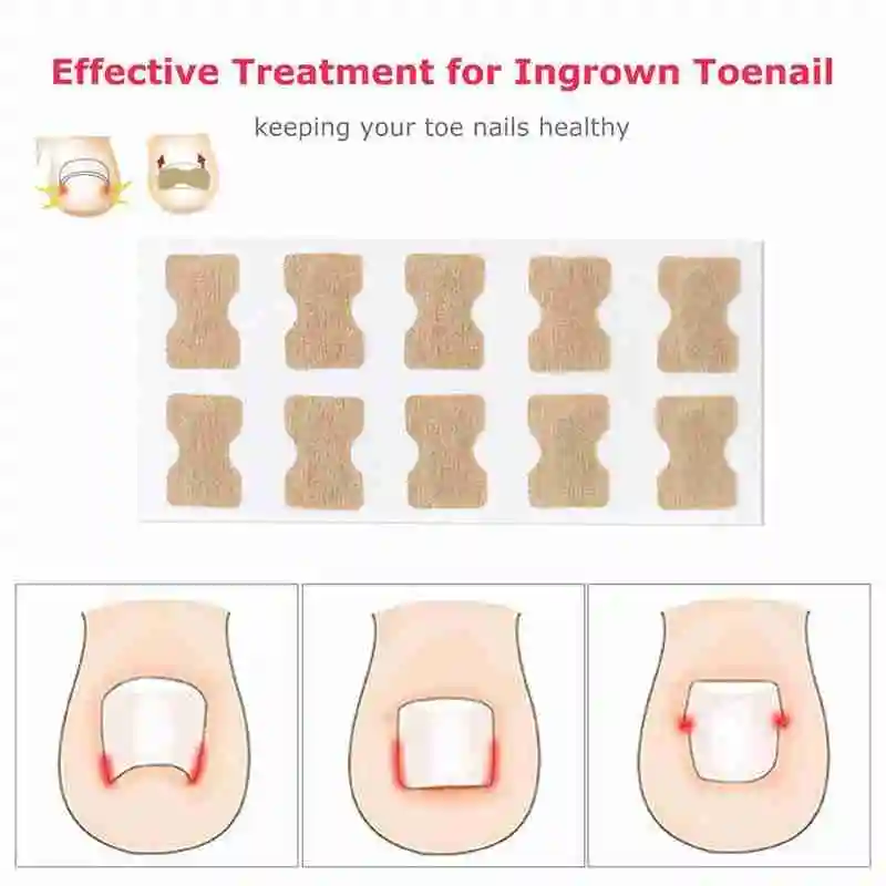 10pcs Ingrown Toenail Corrector Stickers Fingernail Toe Nail Corrector Patch Paronychia Inlays Treatment Care Pedicure Tools Hot