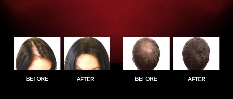CE Лазерный шлем для роста волос, FCC терапия, стимулирующая регенерацию волосяного фолликула, регенерация волос, восстанавливающая крышка, Casco para calcimiento del cabello